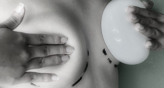 El síndrome de Asia, el padecimiento que lleva a cientos de colombianas a retirarse las prótesis mamarias por salud y amor propio